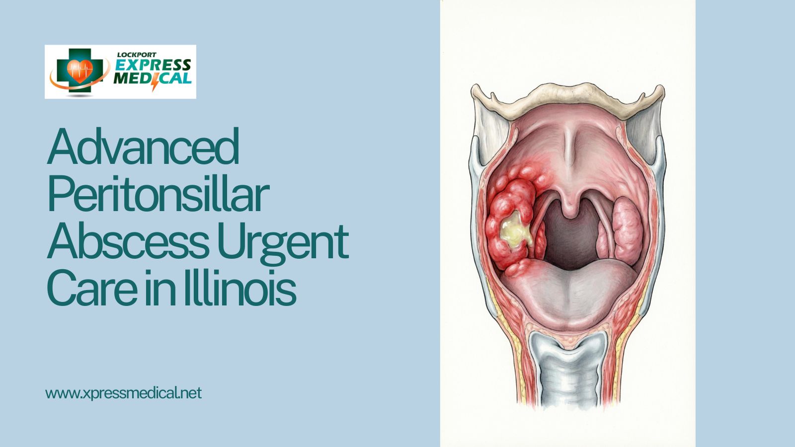 Peritonsillar Abscess Urgent Care