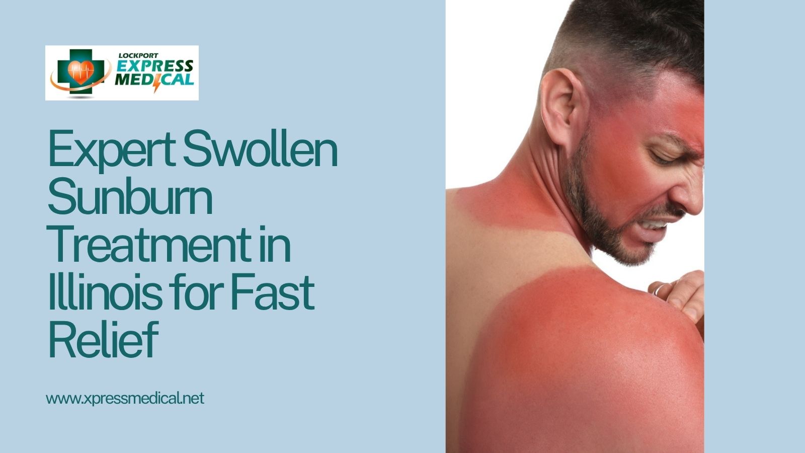 Swollen Sunburn Treatment