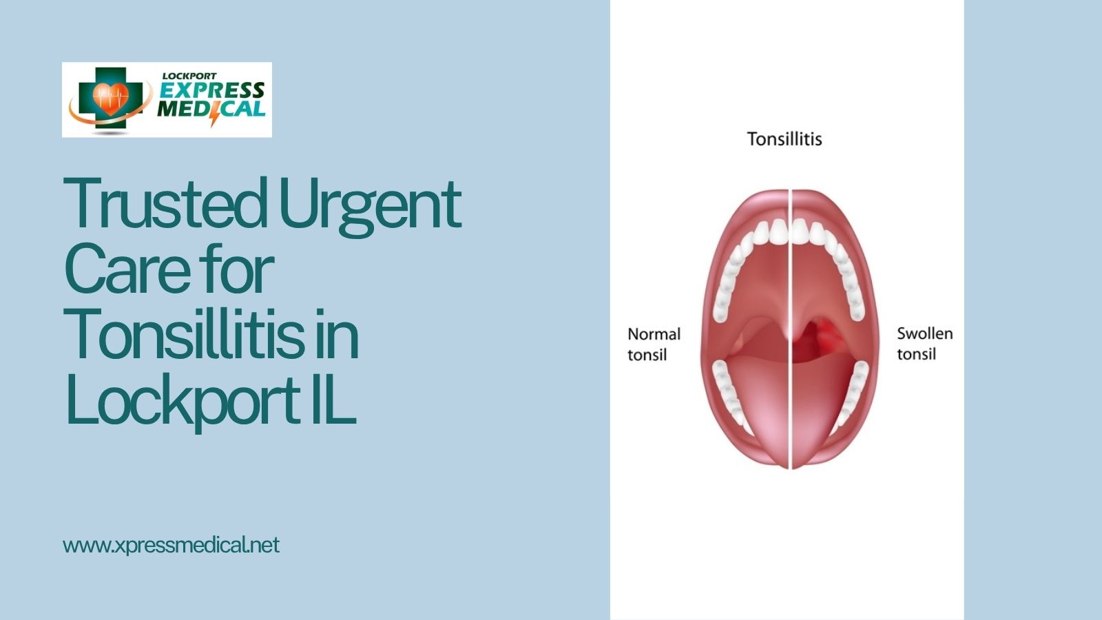 Trusted Urgent Care for Tonsillitis in Lockport IL